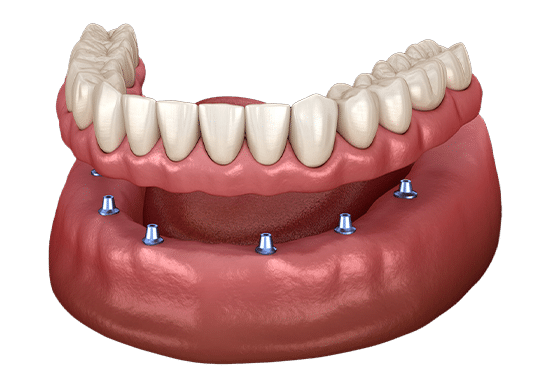 Dental implant model showing prosthetic teeth attached to jawbone with multiple implant posts.