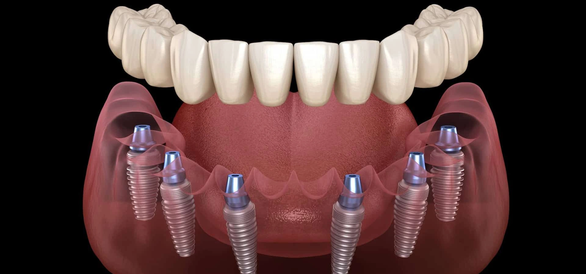 Dental implants diagram showing prosthetic teeth attached to jawbone implant posts.