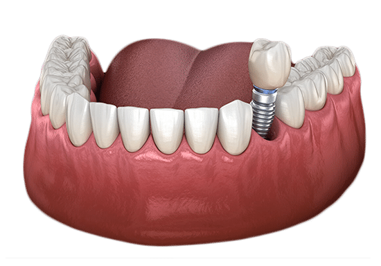Dental implant illustration showing artificial tooth crown attached to jawbone model in cross-section.