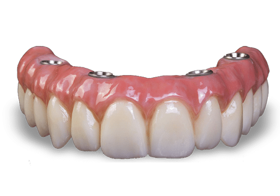 Dental prosthetic model showing upper teeth implants with pink gum tissue and white tooth crowns.