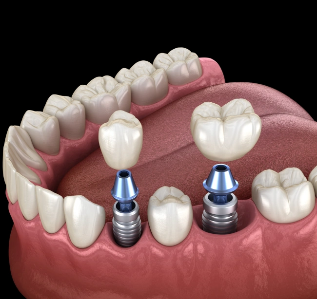 Dental implants demonstration showing two prosthetic teeth mounted on blue implant posts in gum model.