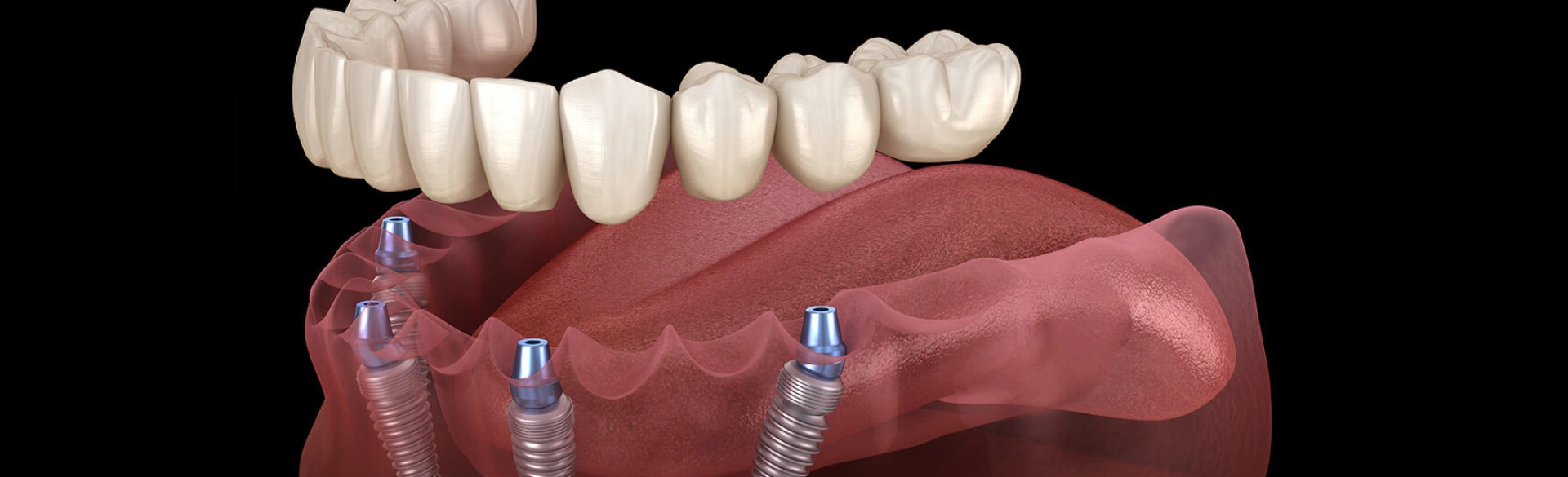 Dental implant bridge prosthesis displayed above model jaw with two implant abutments