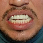 Man displaying bright white teeth in a smile, showcasing dental health results.