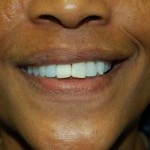 Close-up of person smiling, displaying bright white teeth and healthy gums.