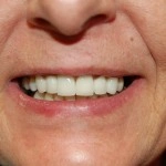 Close-up of person smiling, displaying healthy white teeth and natural gums.