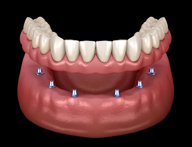 Dental implant diagram showing prosthetic teeth attached to jawbone with metal implant posts.