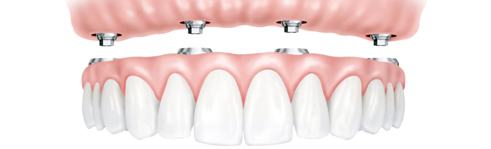Dental implant bridge model showing artificial teeth and pink gum prosthetics for cosmetic dentistry demonstration.