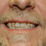 Close-up of man's smile showing teeth and facial hair, demonstrating dental results.