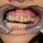 Patient's open mouth showing teeth with dental retractor during examination at Cooper Family Dentistry.