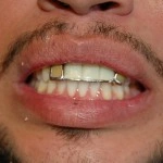 Close-up of person's smile showing teeth and gums before dental treatment