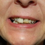 Close-up of person's smile showing teeth and mouth during dental examination or consultation.