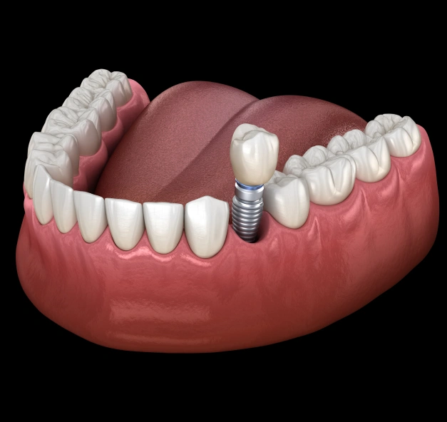 3D dental implant model showing tooth replacement in lower jaw against black background