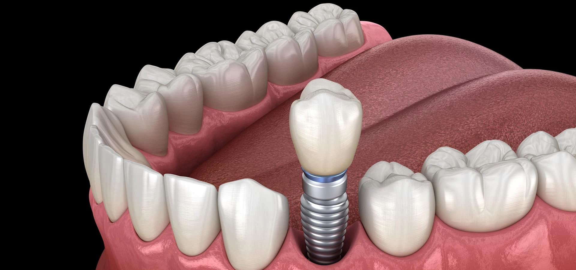 Dental implant model showing artificial tooth fixture in jawbone with surrounding natural teeth.