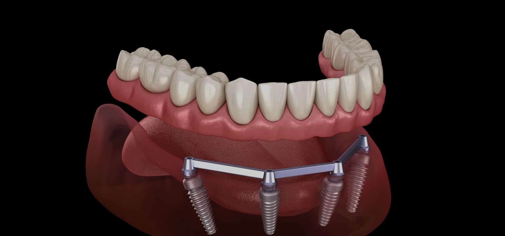 Dental implant prosthetic model showing artificial teeth attached to jawbone structure with implant posts.