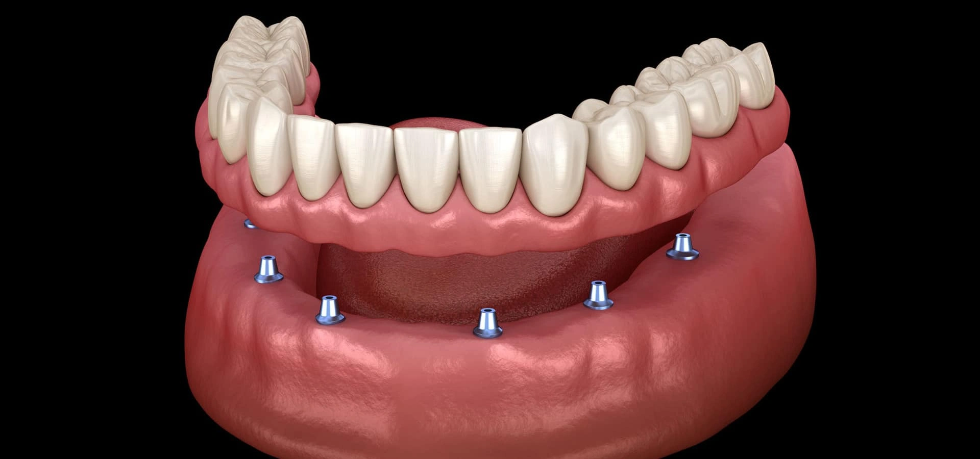 Dental implant model showing prosthetic teeth attached to jawbone with implant posts.