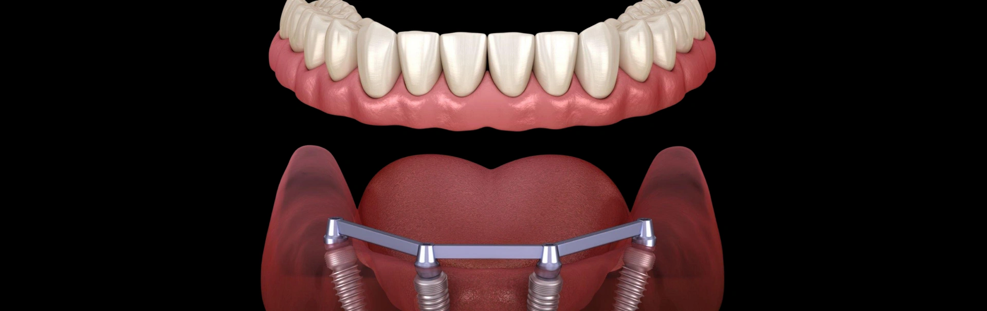 Dental implants illustration showing prosthetic teeth attached to jawbone model in clinical setting.