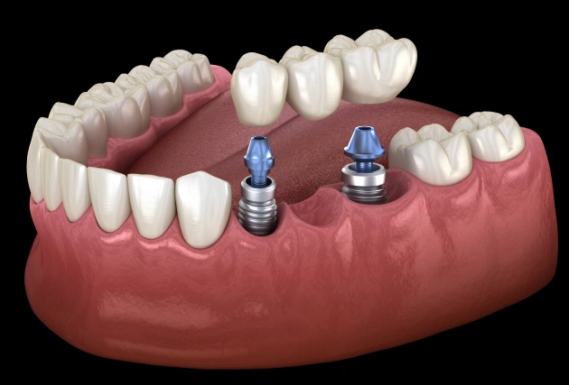 Dental implants demonstration showing titanium posts inserted in jawbone model with crown restoration.