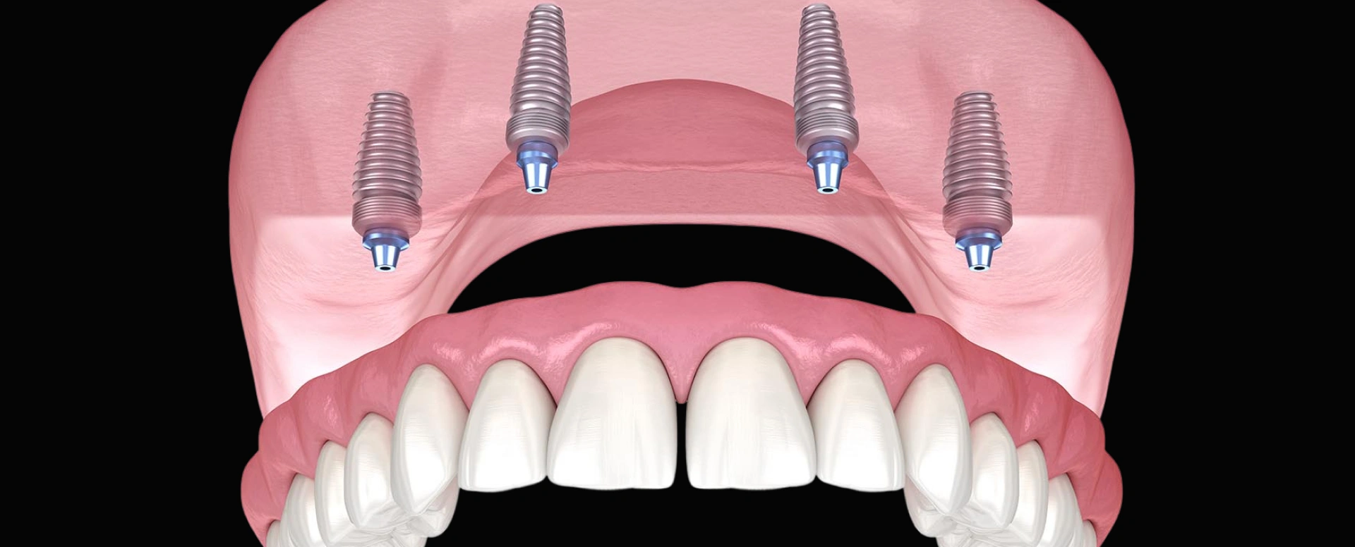Dental implant model showing four titanium posts anchored in pink jaw bone with prosthetic teeth.